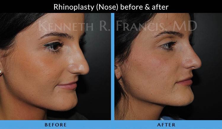 Rhinoplasty before and after 4 Rhinoplasty (Nose) before and after