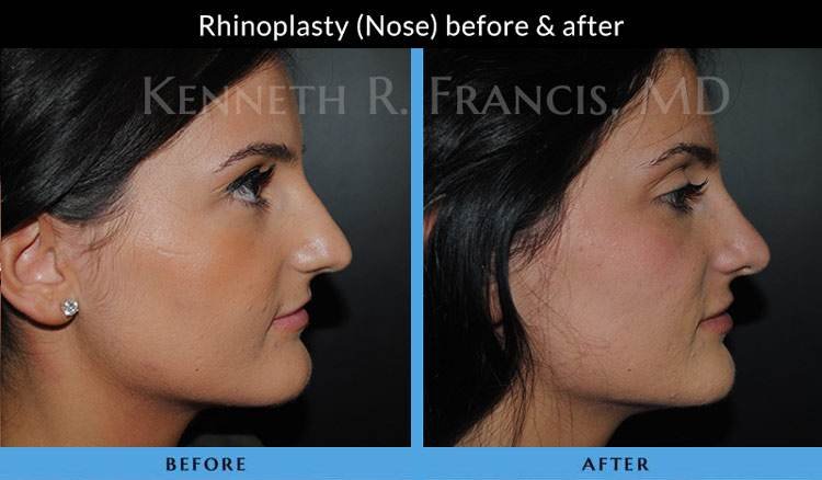Rhinoplasty before and after 5 Rhinoplasty (Nose) before and after