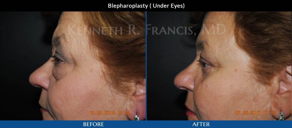 Blepharoplasty ( Under Eyes) Plastic Surgeons Manhattan, NYC