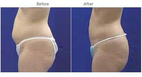 liposuction NYC