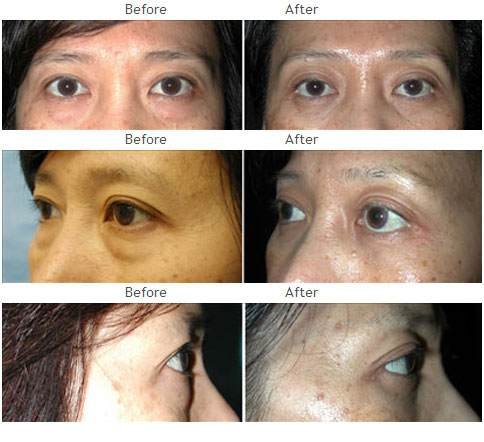 Blepharoplasty (Eyelid)
