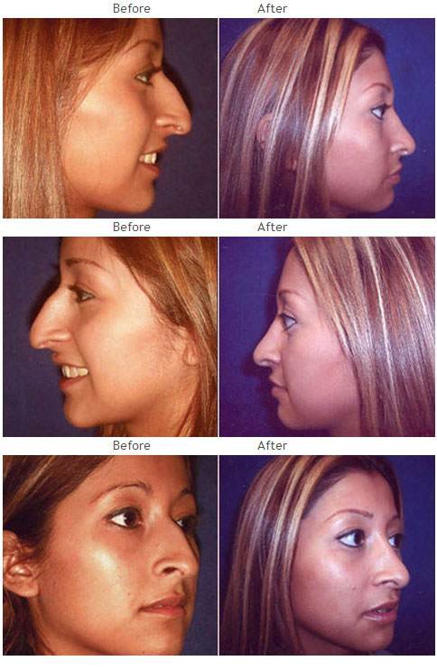 Rhinoplasty before and after 8 Rhinoplasty (Nose) before and after