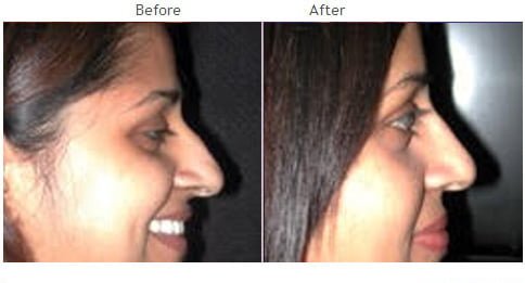 Rhinoplasty before and after 9 Rhinoplasty (Nose) before and after