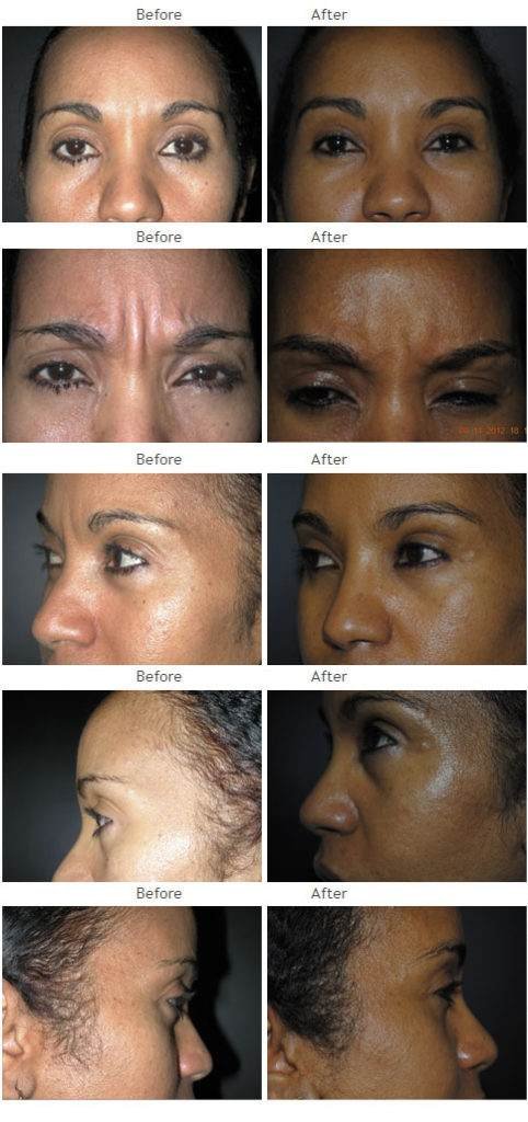 Blepharoplasty (Eyelid) NYC