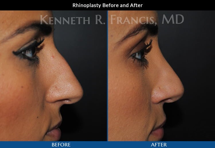 Rhinoplasty before and after 6 Rhinoplasty (Nose) before and after