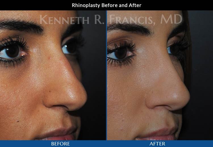 Rhinoplasty before and after 7 Rhinoplasty (Nose) before and after