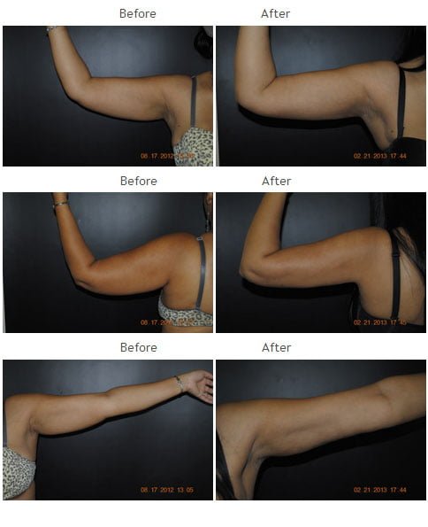 Arm Liposuction NYC Case 1012 - Kenneth R. Francis, MD