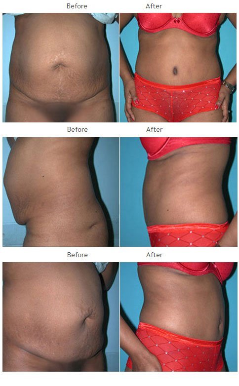Case 1013 Tummy Tuck
