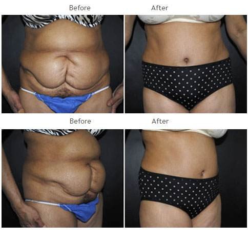 Case 1018 Tummy Tuck