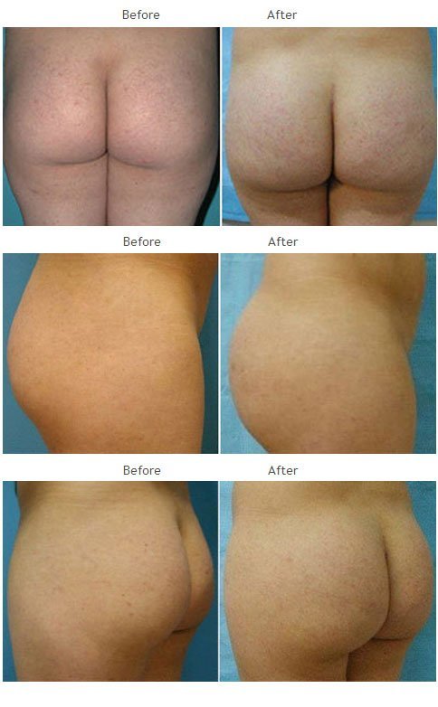 Brazilian Butt Lift NYC Case 1025