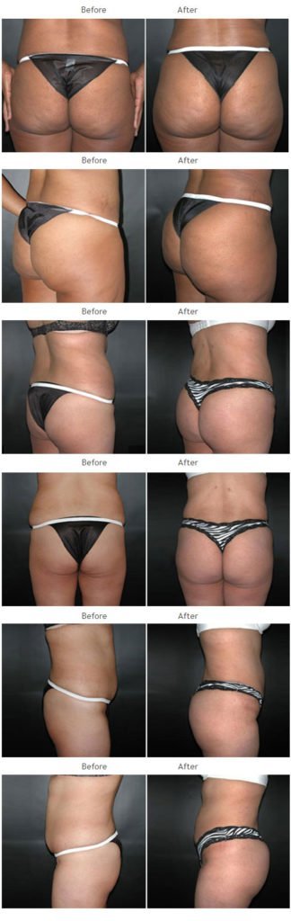 Brazilian Butt Lift NYC Case 1028