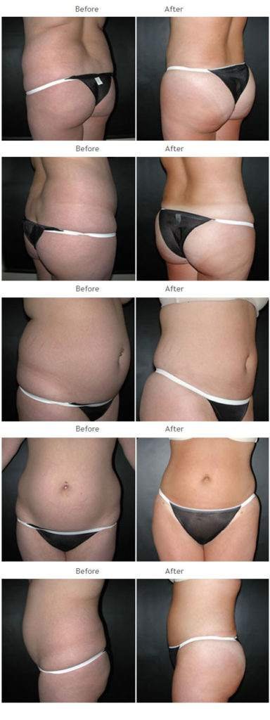 Brazilian Butt Lift NYC Case 1029