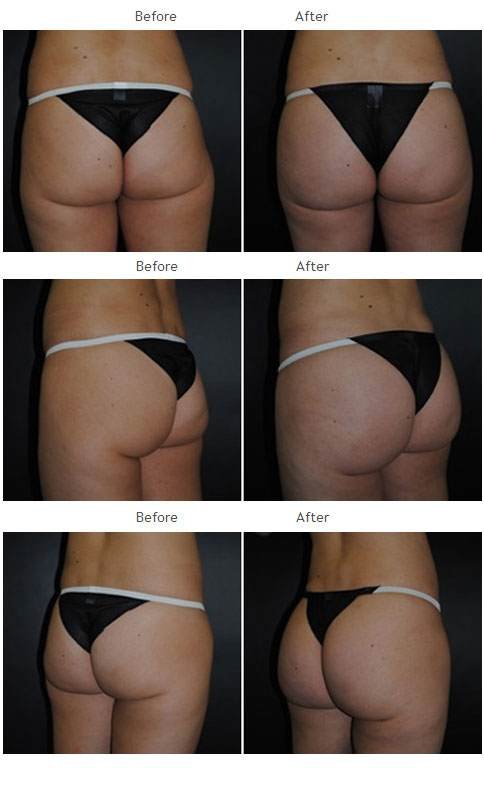 Brazilian Butt Lift NYC Case 1033