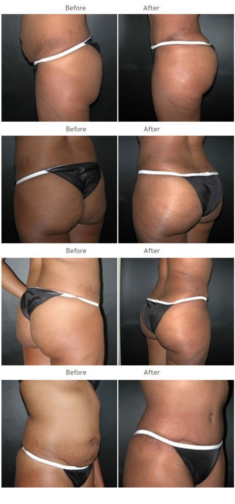 Brazilian Butt Lift NYC Case 1035