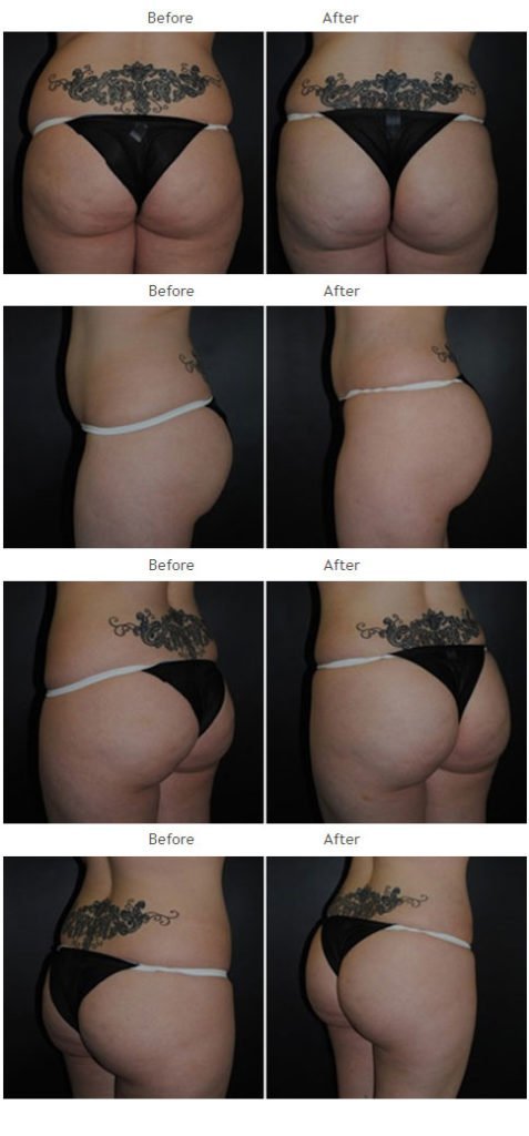 Brazilian Butt Lift NYC Case 1036