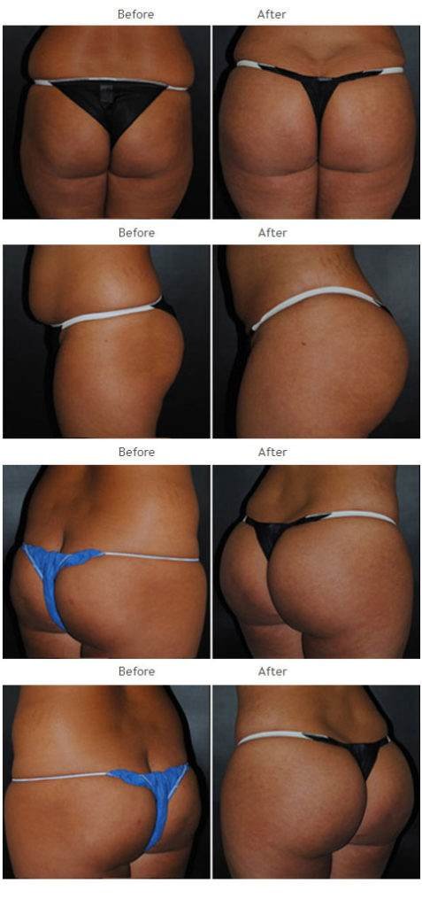 Brazilian Butt Lift NYC Case 1037
