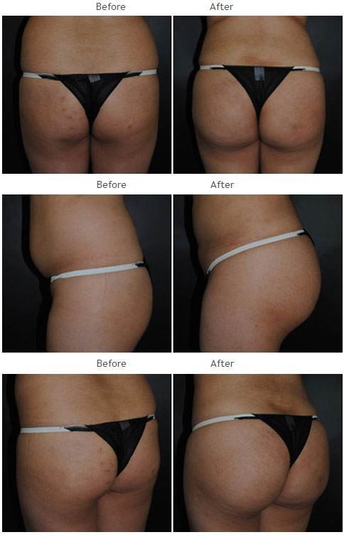 Brazilian Butt Lift NYC Case 1038