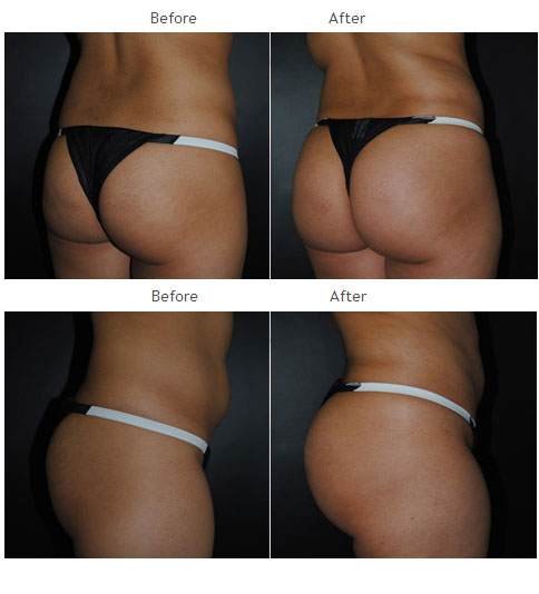 Brazilian Butt Lift NYC Case 1041