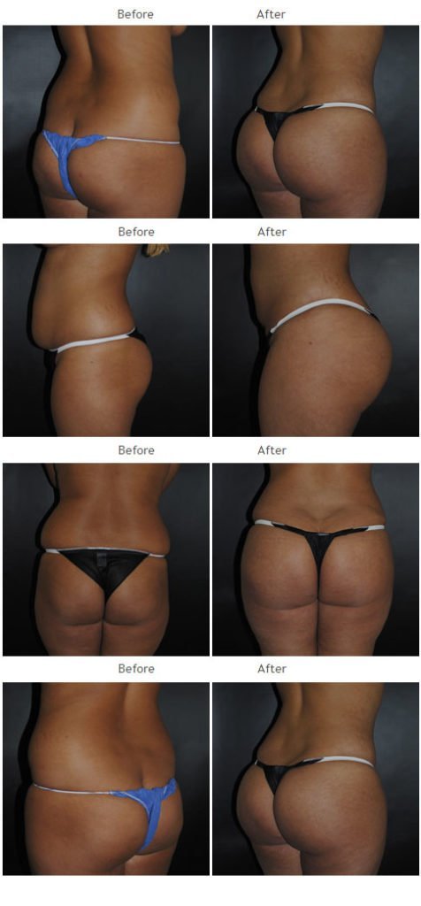 Brazilian Butt Lift NYC Case 1043