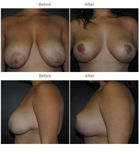 Breast Lift Case 1065