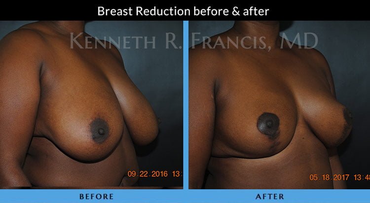 Breast Reduction NYC Case 1071