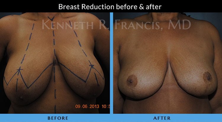 Breast Reduction NYC Case 1072