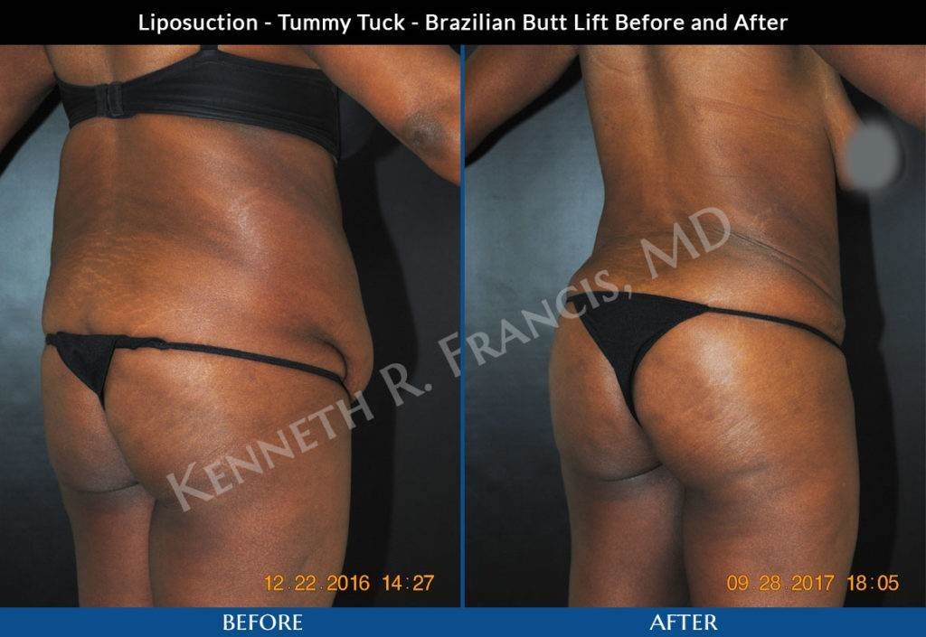 Liposuction, Brazilian butt lift, Tummy tuck NYC