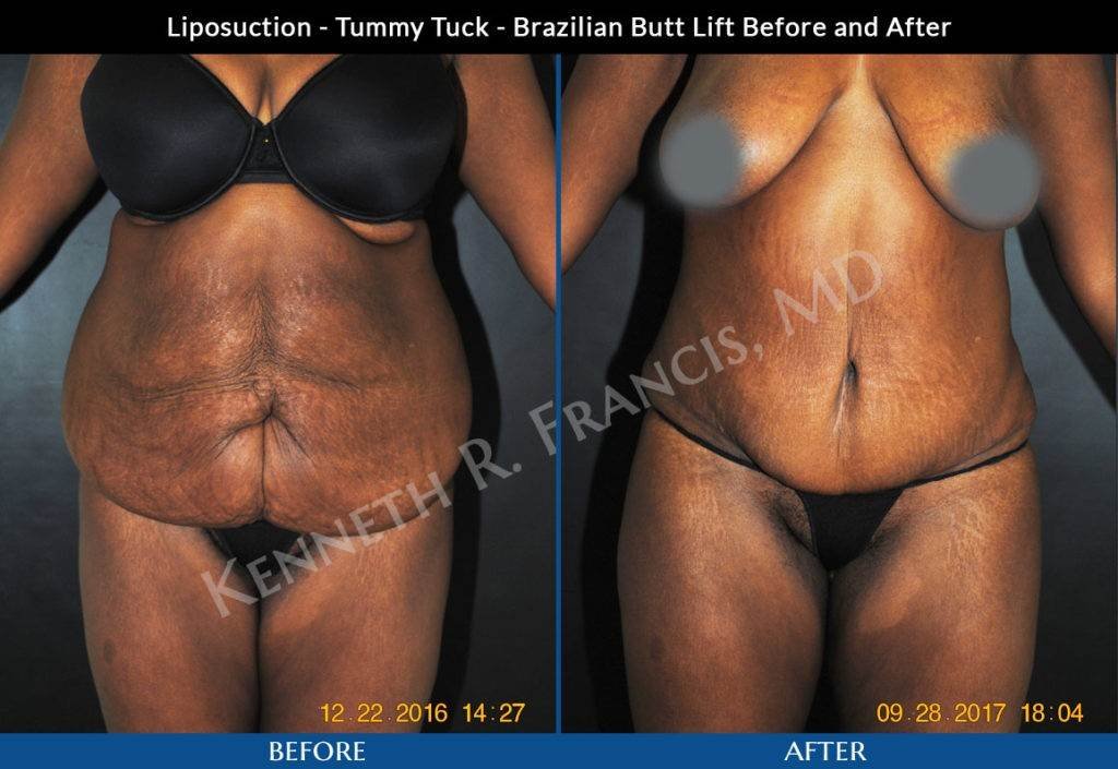 Liposuction, Brazilian butt lift, Tummy tuck NYC