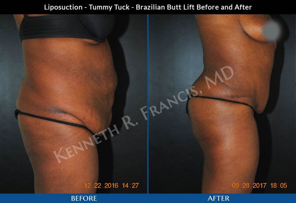 Liposuction, Brazilian butt lift, Tummy tuck NYC