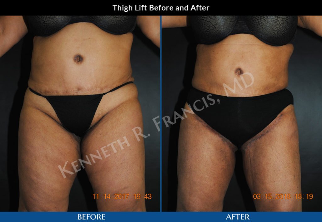 Thigh Lift surgeons manhattan