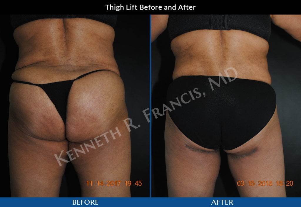 Thigh lift before and after