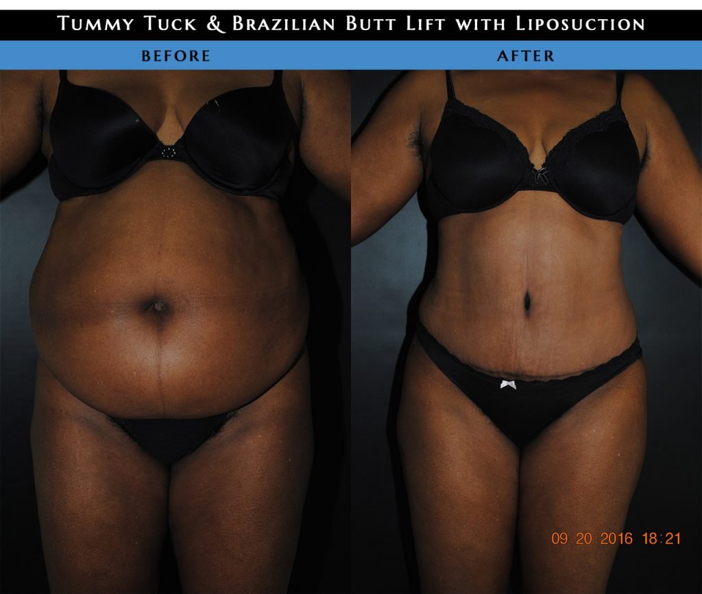 Tummy tuck before and after