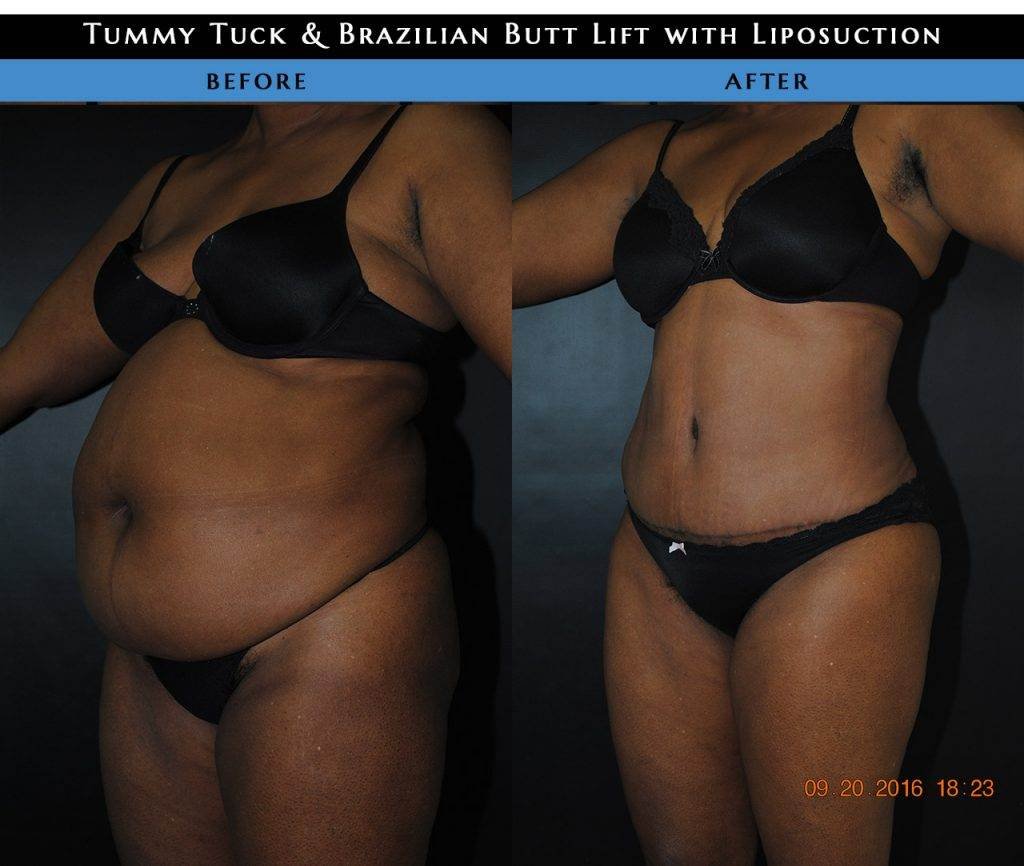 Tummy tuck before and after