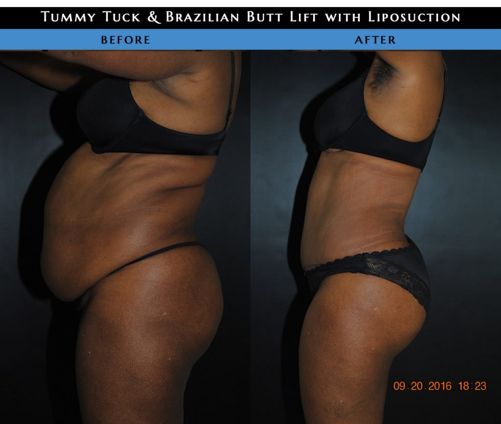 Tummy tuck before and after