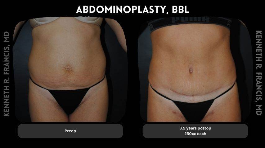 Abdominoplasty, BBL
