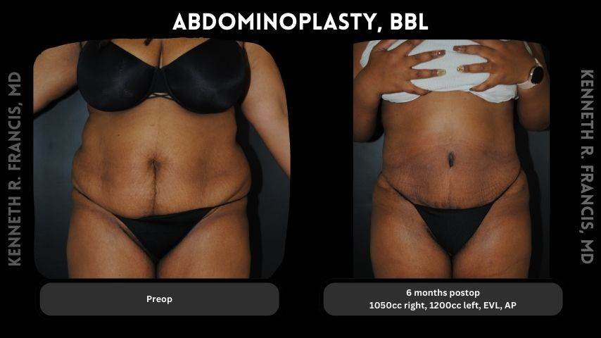 Abdominoplasty, BBL