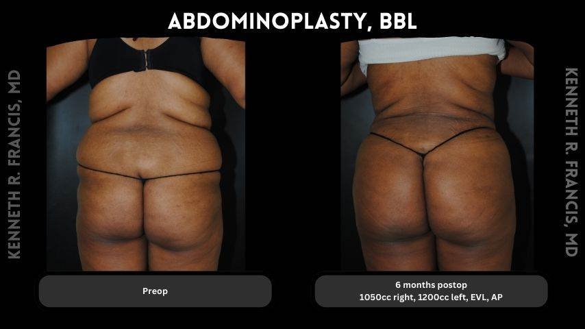 Abdominoplasty, BBL