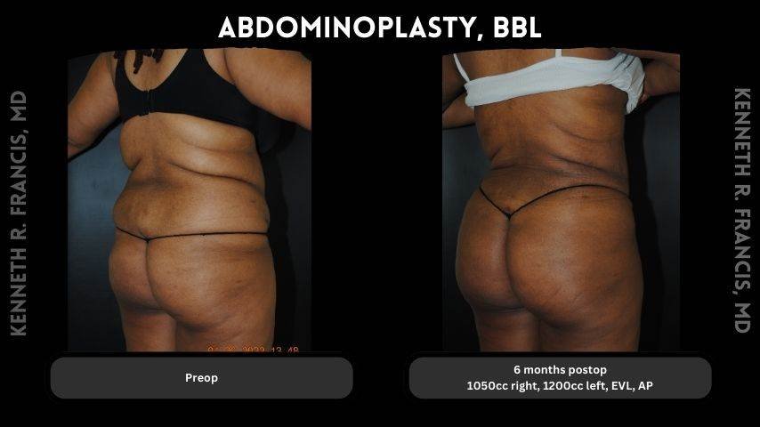 Brazilian butt lift before and after