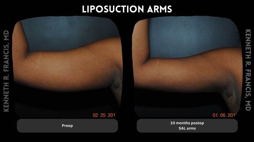 Arms Liposuction