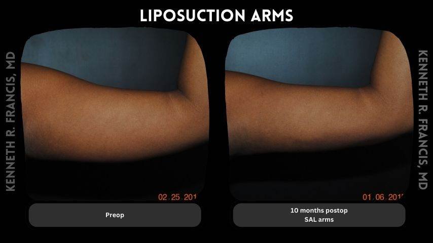 Arms Liposuction