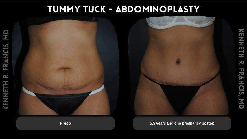 Tummy tuck before and after