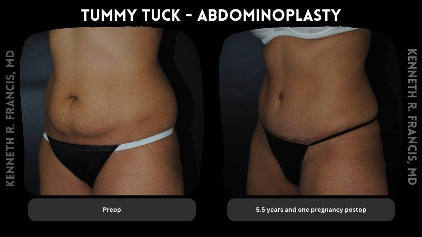 Tummy tuck - Abdominoplasty