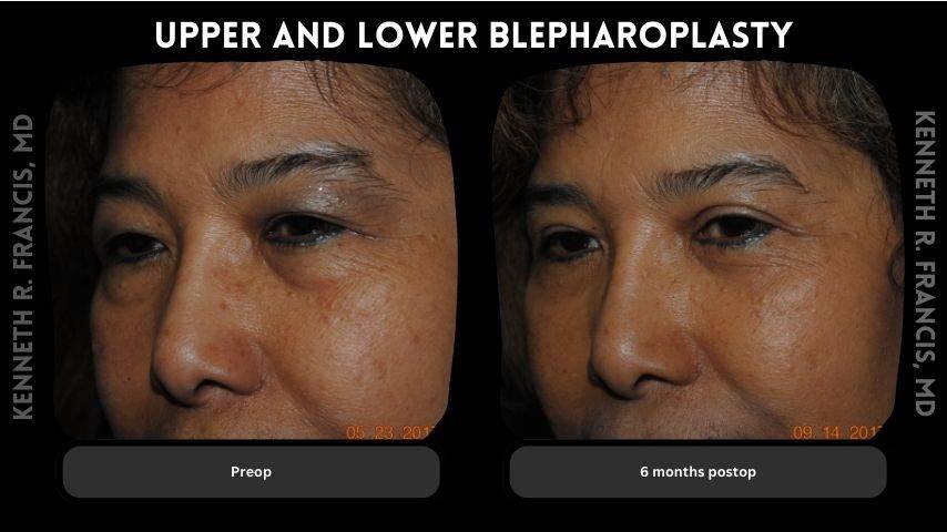 Upper and lower blepharoplasty