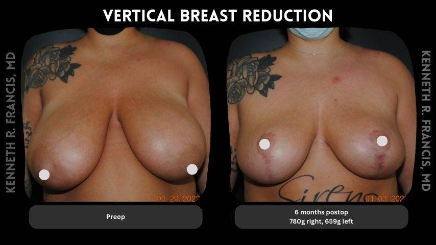 Vertical breast reduction