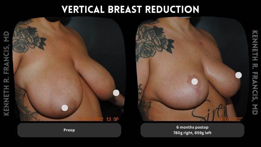 Vertical breast reduction