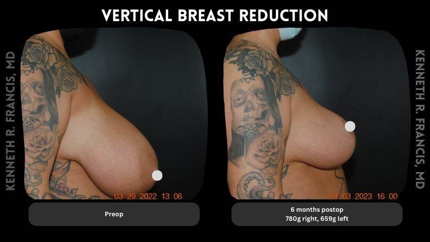 Vertical breast reduction