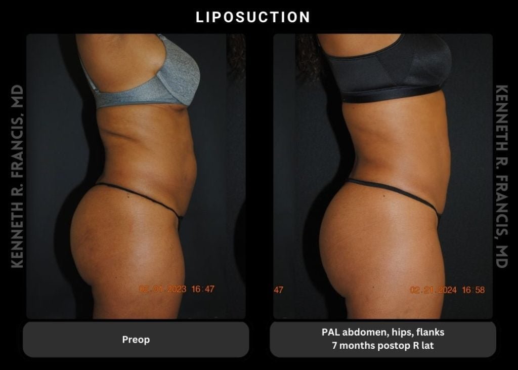 liposuction PAL abdomen hips flanks 7 months postop AP
