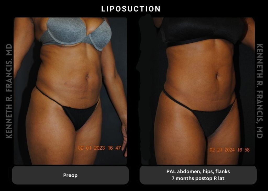 liposuction PAL abdomen hips flanks 7 months postop AP