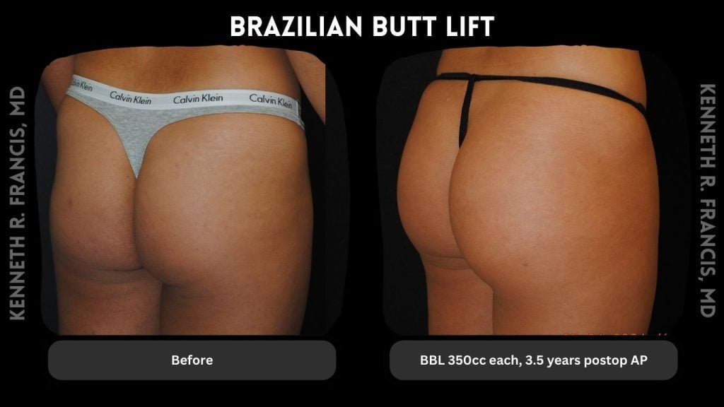 BBL 350cc each-3.5 years postop