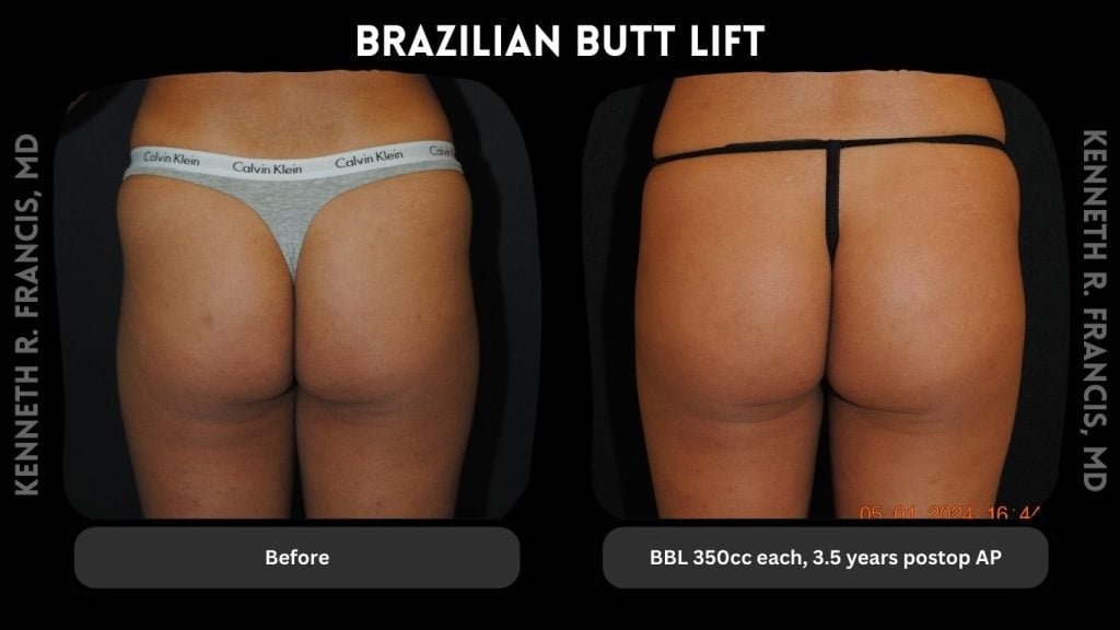 BBL 350cc each-3.5 years postop